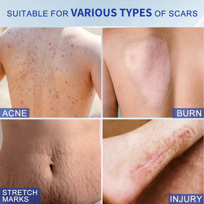 Silicone Scar Cream for Old and New Scars