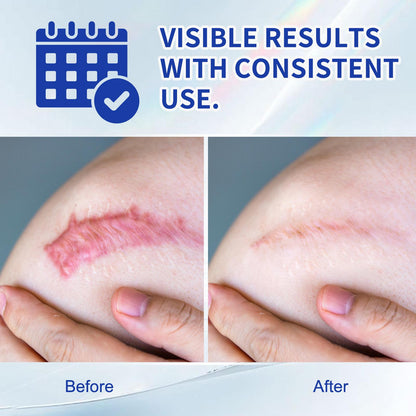 Silicone Scar Cream for Old and New Scars