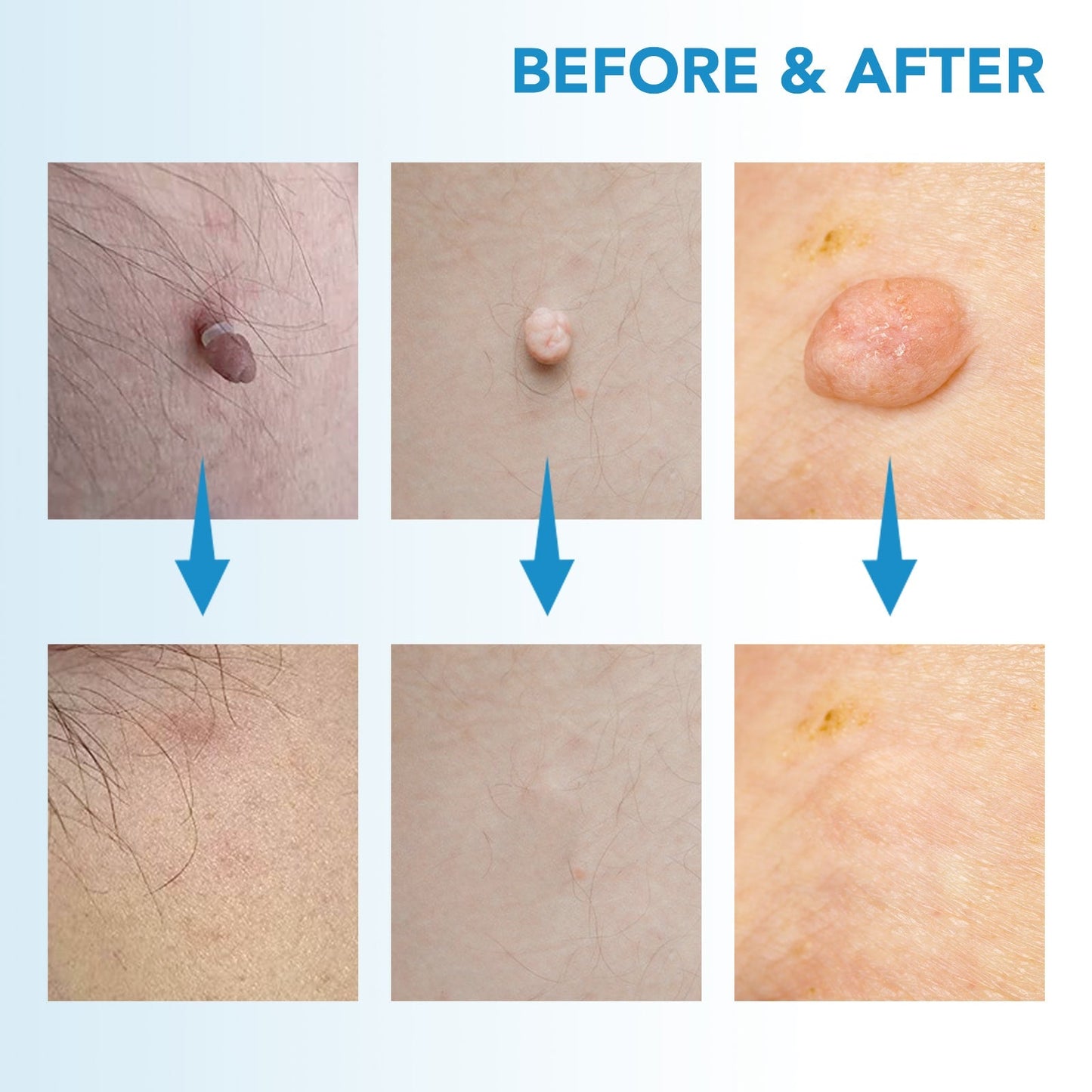 MicroCare Skin Solution - Advanced Skin Tag, Wart, Acne, and Pimple Removal Kit