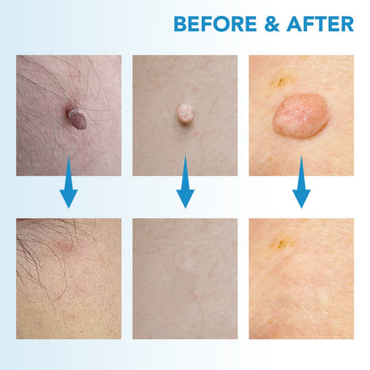 MicroCare Skin Solution - Advanced Skin Tag, Wart, Acne, and Pimple Removal Kit