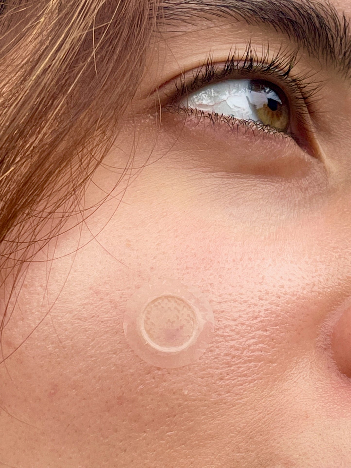 Microdarts Acne Patches (Instant acne treatment)